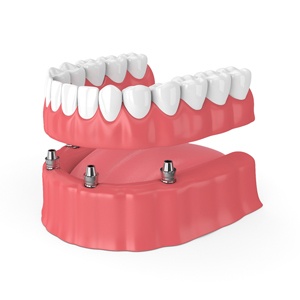four implant-retained dentures