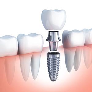 diagram of dental implant