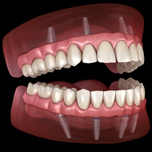 An image showing All-On-4 implants