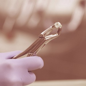 Dentist holding a wisdom tooth with pliers