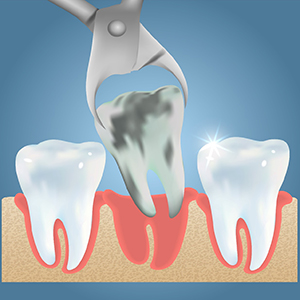 illustration of tooth extractions