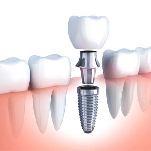 diagram showing the placement of a dental implant