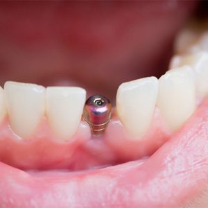 closeup of dental implant in mouth  