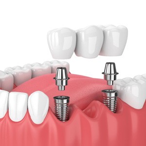 dental bridge implants