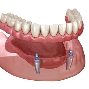 implant denture 