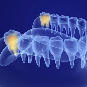 an illustration highlighting where wisdom teeth are located