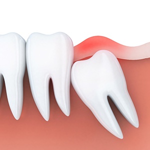 an illustration of an impacted wisdom tooth