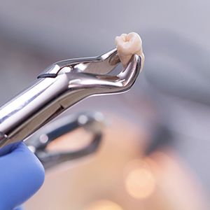 a dentist holding a wisdom tooth with a clasping tool 