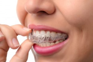 Woman with clear plastic aligner. 